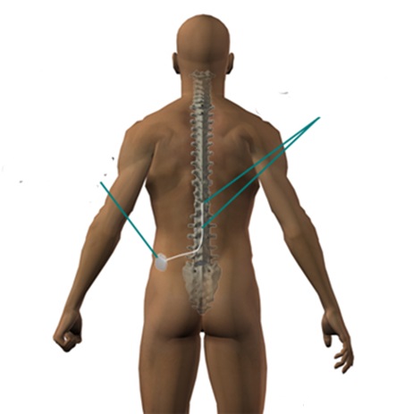 脊髄刺激療法説明