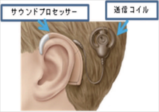 人工内耳（人工聴覚機器）