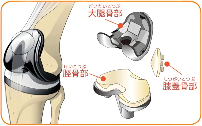 図１　人工膝関節全置換術