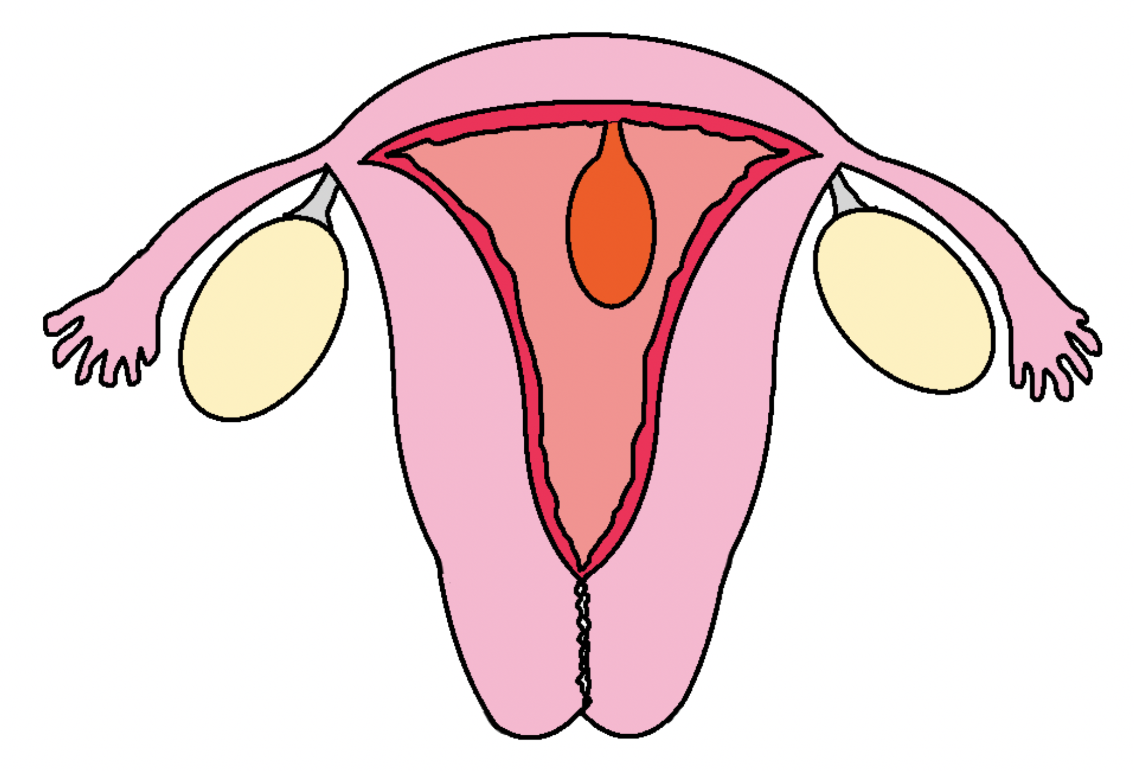 図 子宮内膜ポリープ