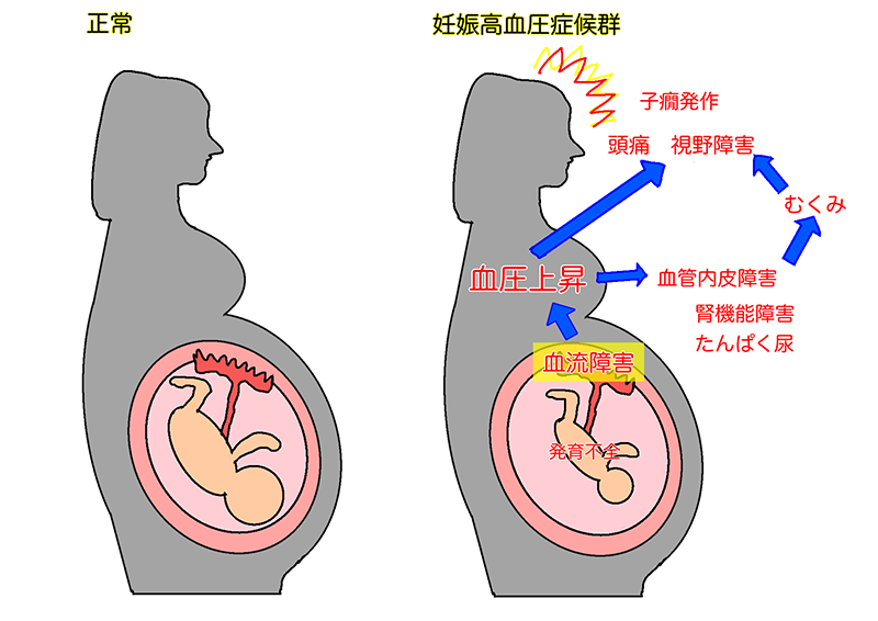 図2妊娠高血圧症候群の病態