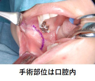 歯科・口腔外科_咀嚼筋腱・腱膜過形成症