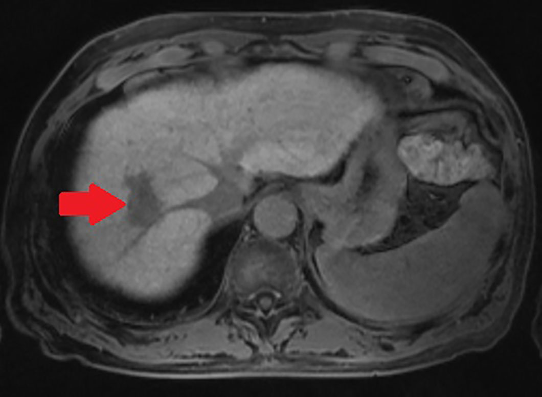 MRI EOB HCC 肝細胞相 marked