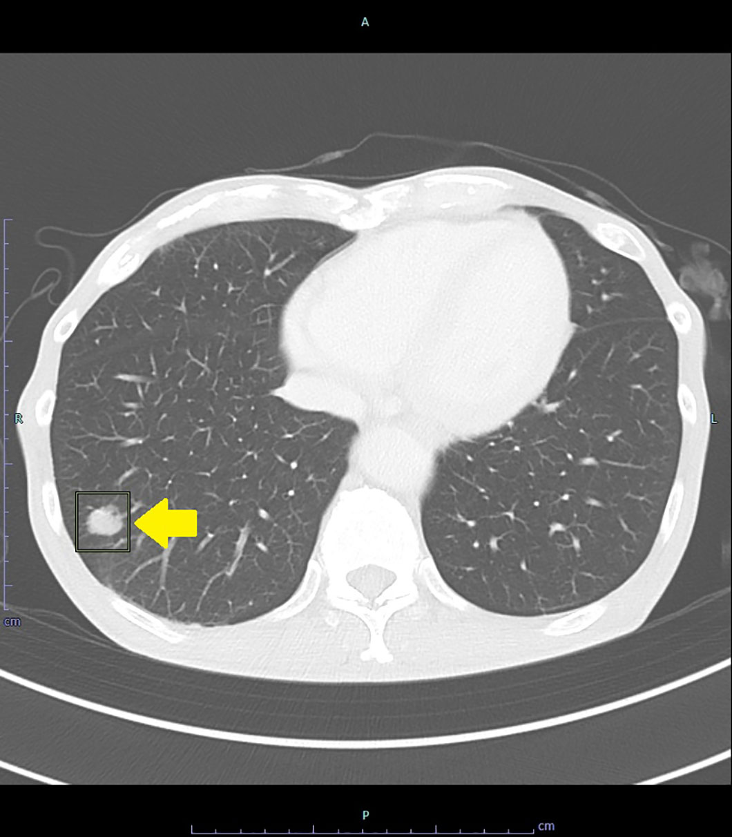 CT 肺転移 AI認識 marked