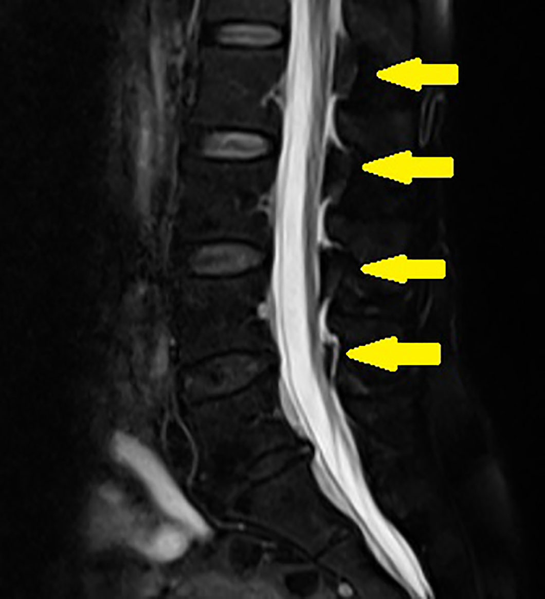 脳脊髄液減少症 MRI dinasour tail sign