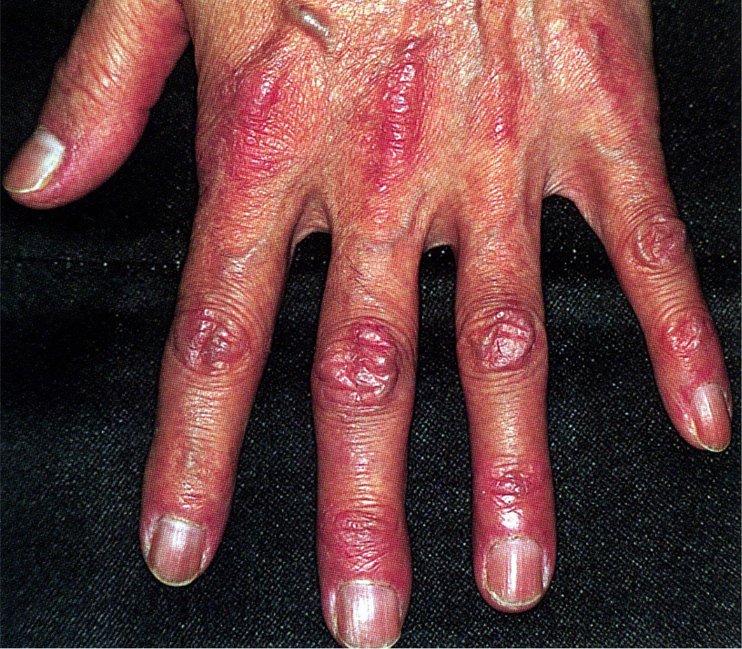図6②　手指のゴットロン兆候・丘疹