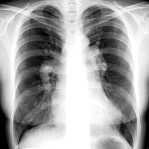 図11. 胸部レントゲン写真、右肺動脈主幹拡張と左II弓突出を示す