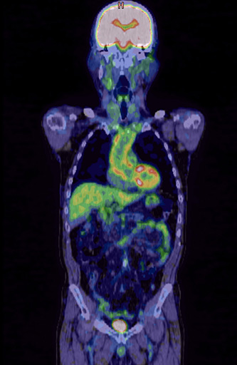 図17. PET-CT像