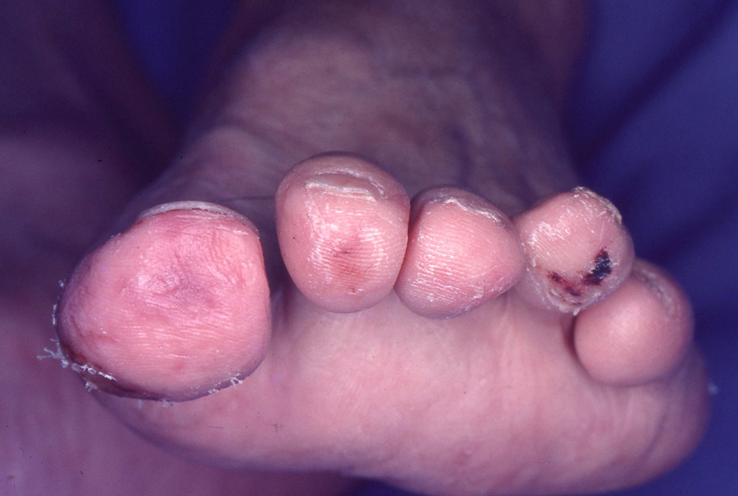 図18. 足趾の血流障害