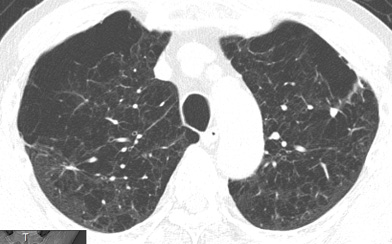 COPD患者さんの胸部CT写真①