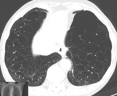 COPD患者さんの胸部CT写真②