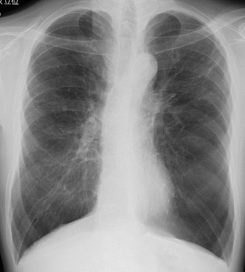 COPD患者さんの胸部エックス線写真