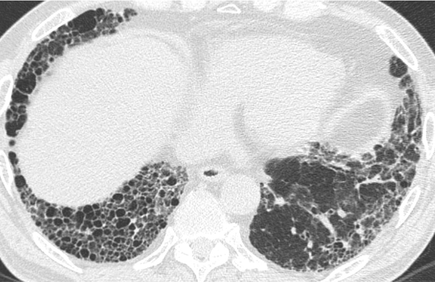 間質性肺炎患者さんの胸部CT写真