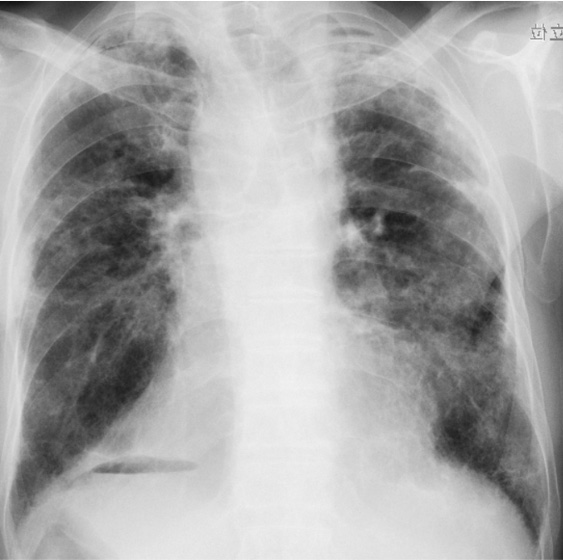 図4 間質性肺炎患者さんの胸部エックス線写真