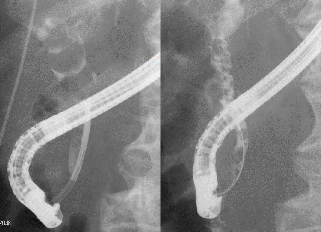 図3　経口胆道鏡を胆管内に挿入し、胆石を破砕しているところ