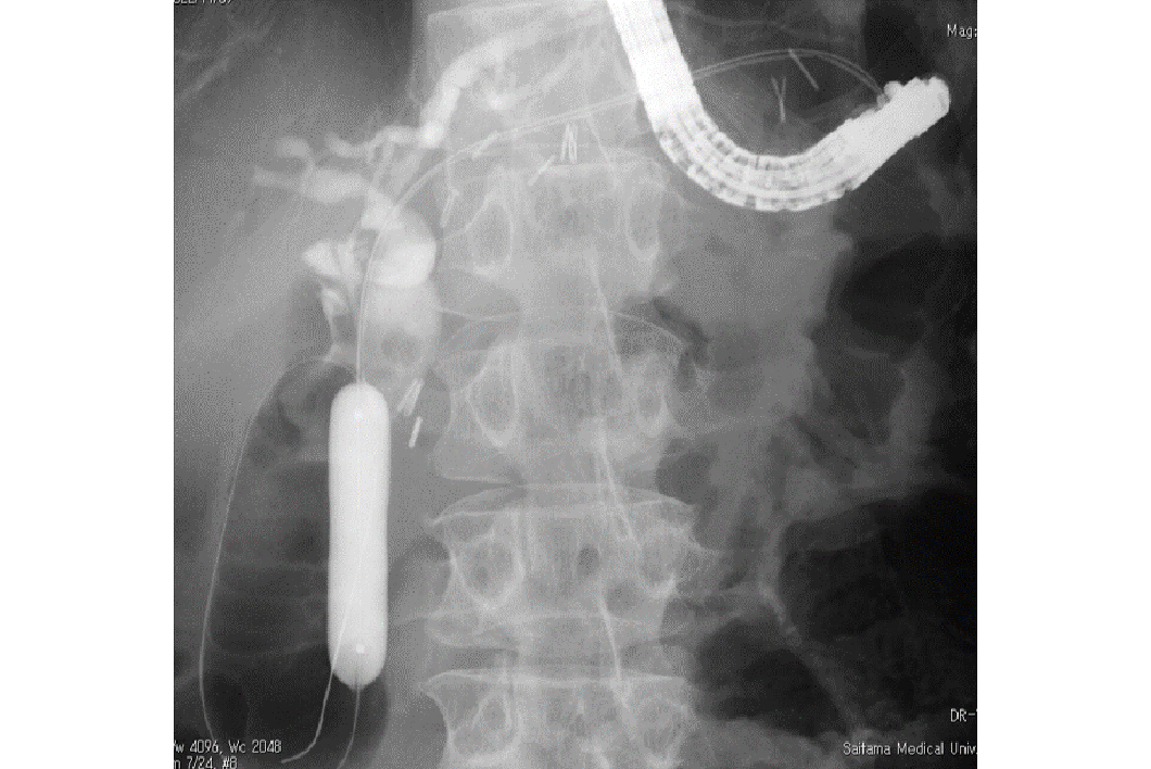 図6　超音波内視鏡を用いた胃術後患者さんの胆管結石治療