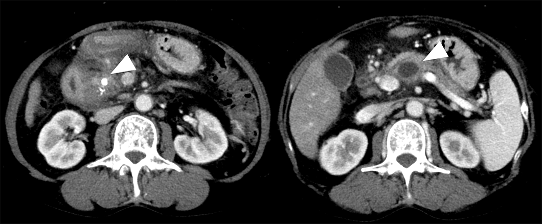 図7　慢性膵炎患者さんのCT画像
