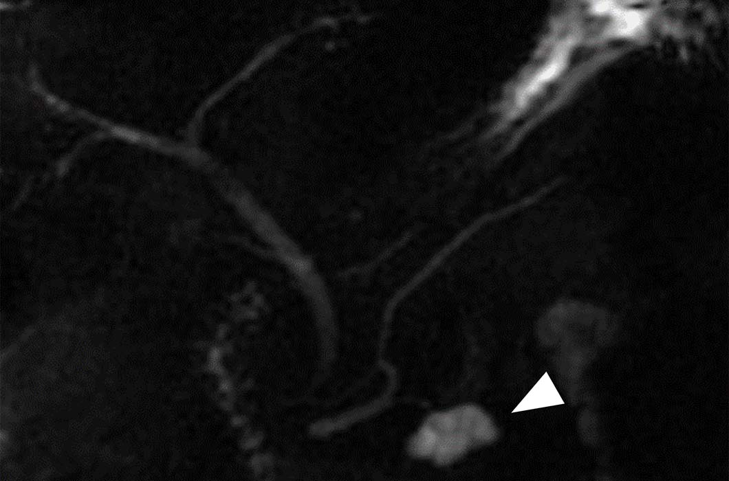 図9　膵管内乳頭粘液性腫瘍（IPMN）のMRCP画像