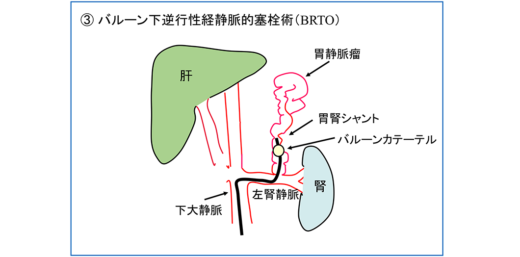 図11　胃静脈瘤に対するカテーテル治療