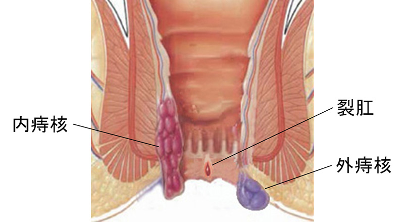 痔核