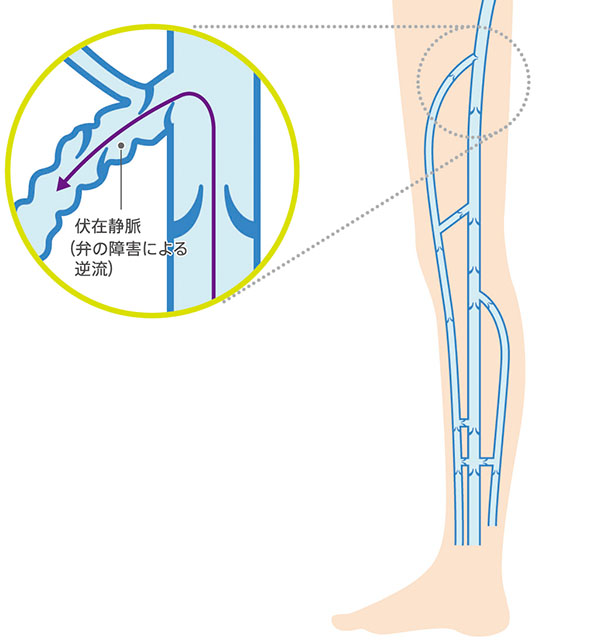 下肢静脈瘤弁不全