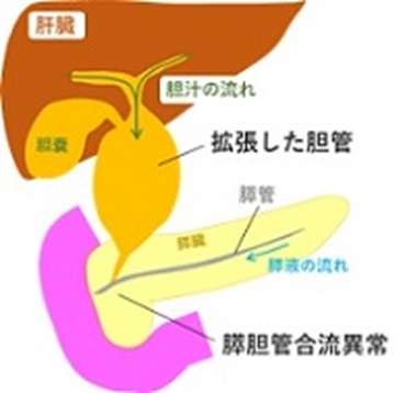 先天性胆道拡張症