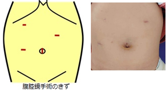 腹腔鏡下胆道拡張症手術