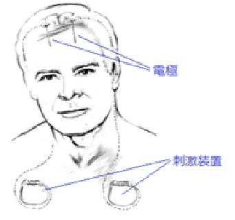 パーキンソン病説明