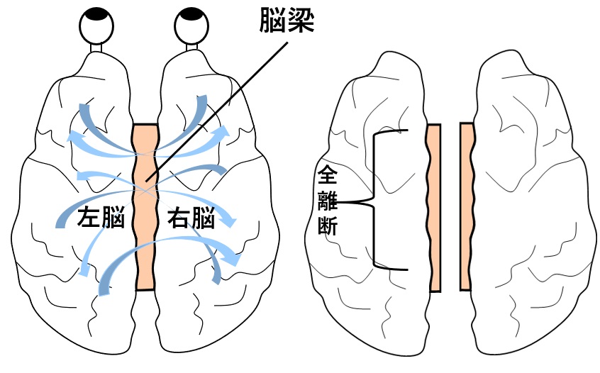 脳梁離断説明