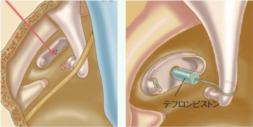 耳硬化症