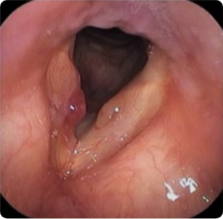 声帯ポリープ