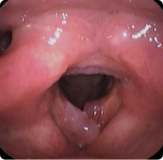 ポリープ様声帯