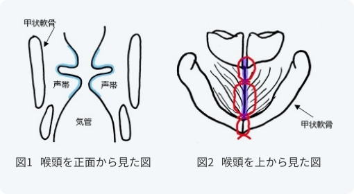 声門閉鎖術