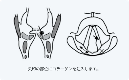 声帯内コラーゲン注入術