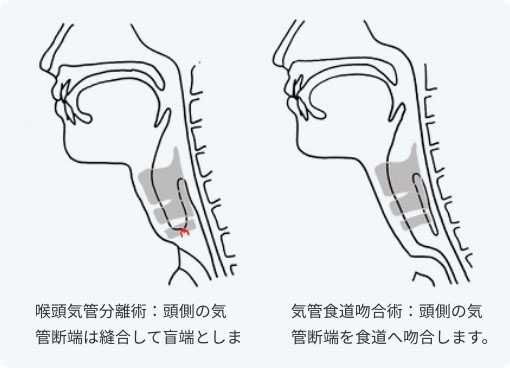 喉頭気管分離術