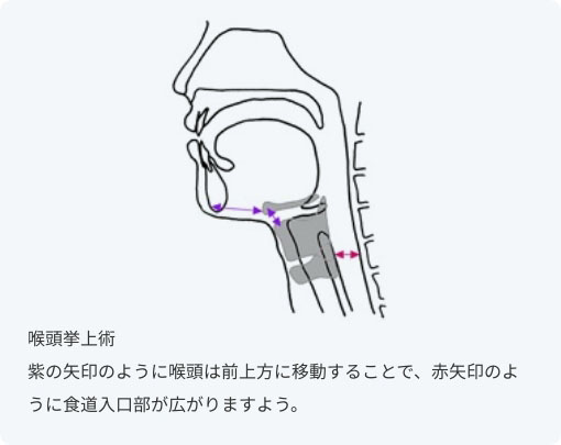 喉頭挙上術