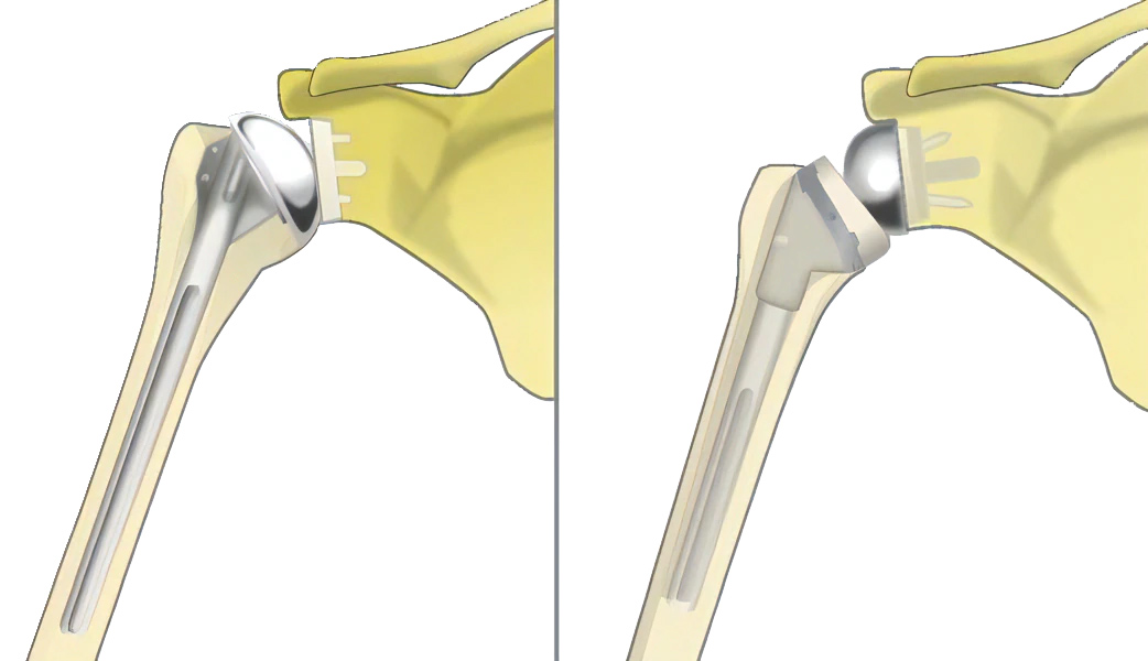 図６　人工肩関節全置換術