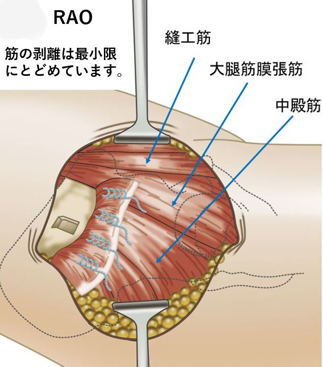 図５ 寛骨臼回転骨切り術（RAO)