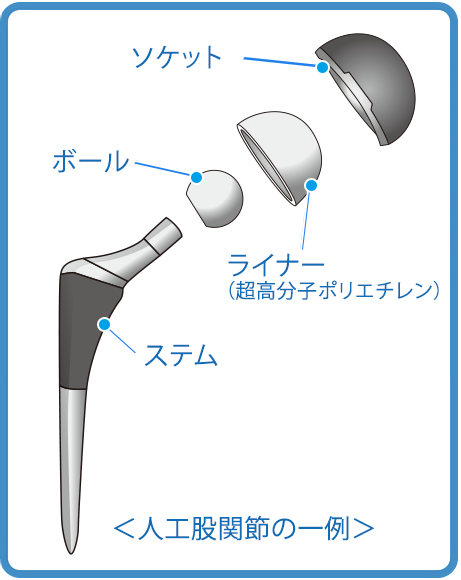 図4　人工股関節全置換術