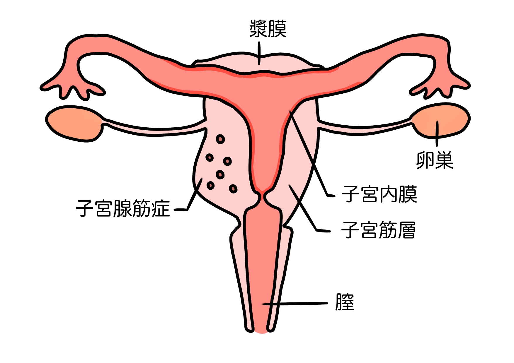 子宮腺筋症　フリーイラスト