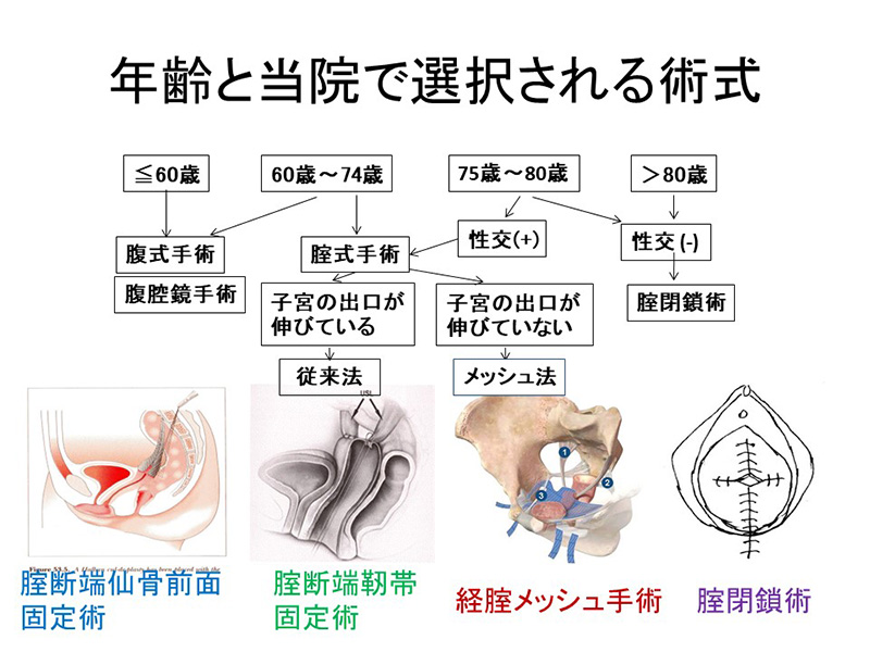 図4骨盤臓器脱手術