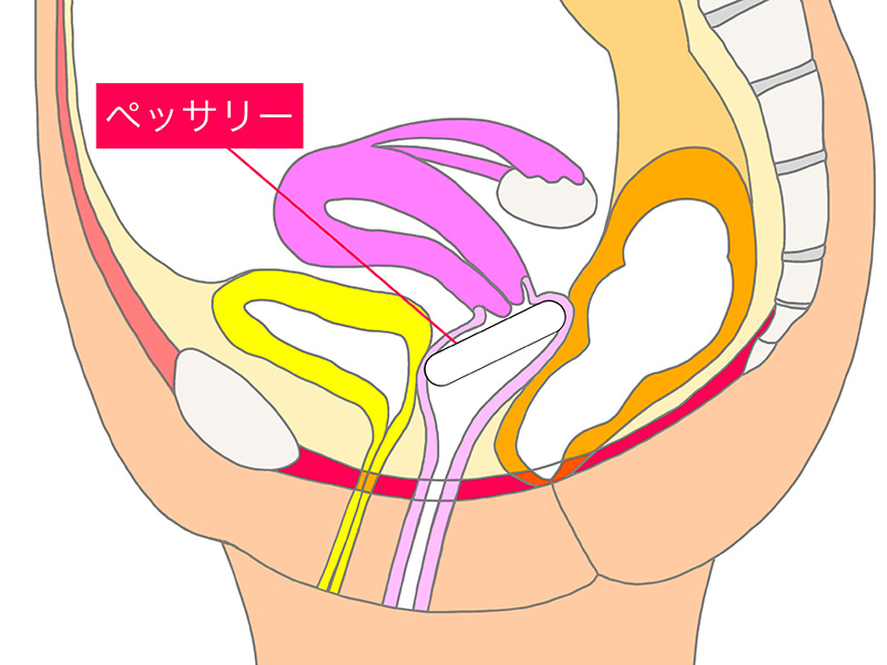 図3ペッサリー挿入図