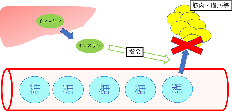 妊娠糖尿病-図2