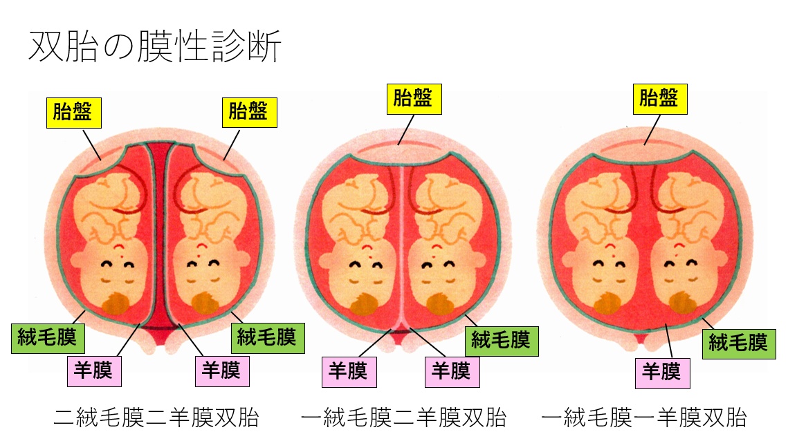 双胎の膜性診断