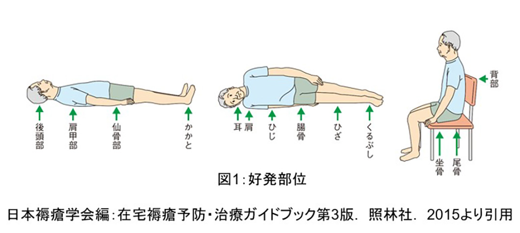 形成外科・美容外科褥瘡_図1