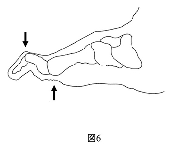 下肢難治性潰瘍_図6