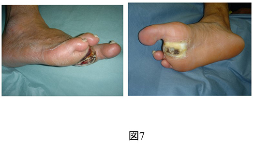 下肢難治性潰瘍_図7