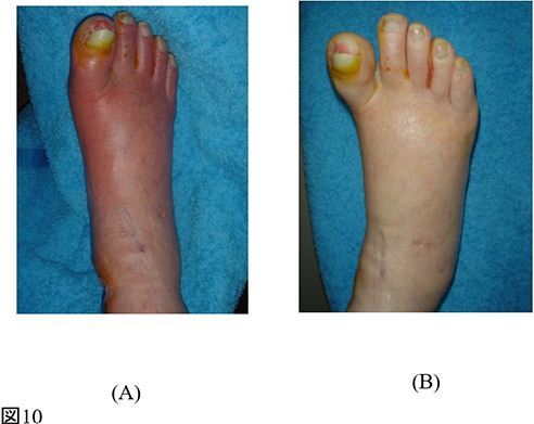 下肢難治性潰瘍_図10