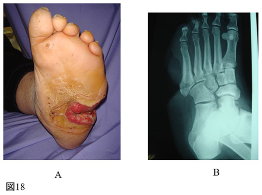 下肢難治性潰瘍_図18