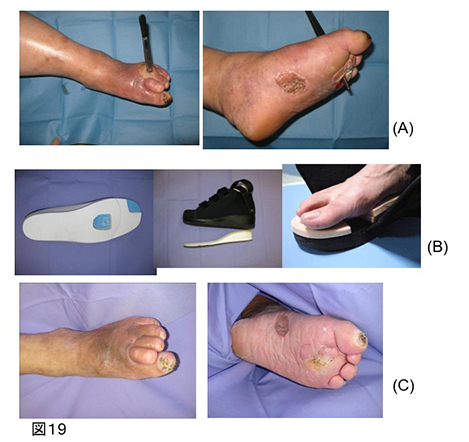下肢難治性潰瘍_図19